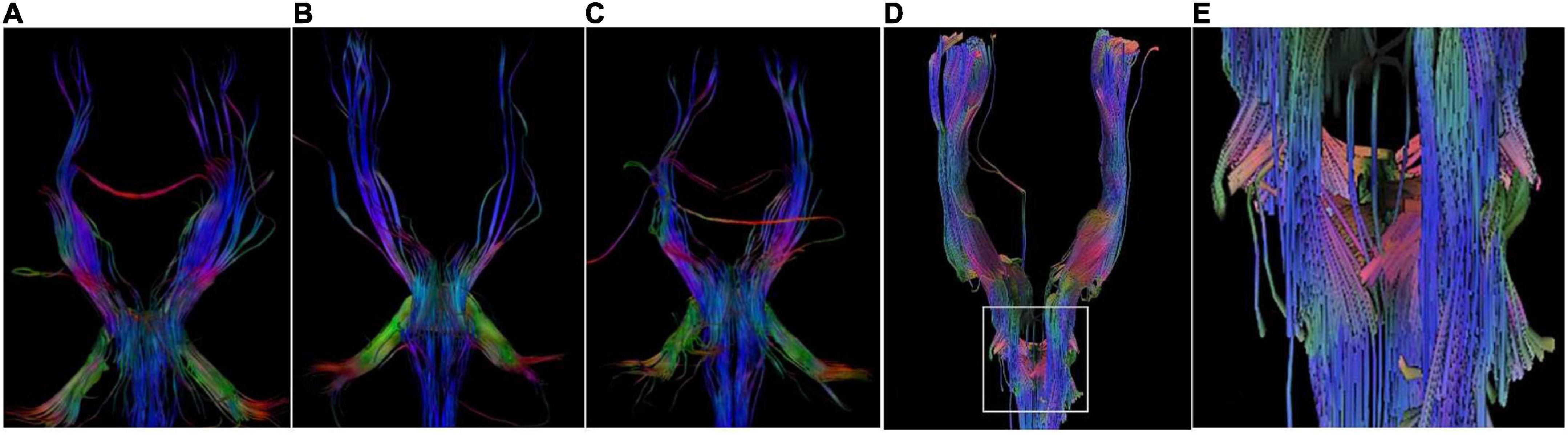 Frontiers | Clinical Features And Genotypes Of Six Patients From Four ...