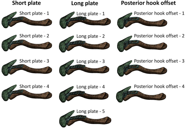 PDF) Biomechanical effects of different numbers and locations of screw-in  clavicle hook plates