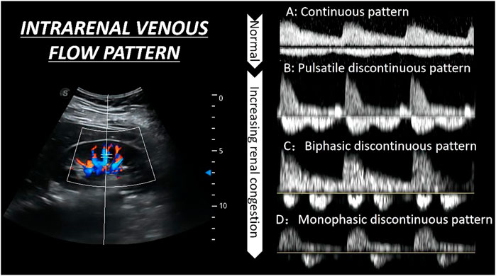 Frontiers Intrarenal Doppler Approaches In Hemodynamics A Major Application In Critical Care