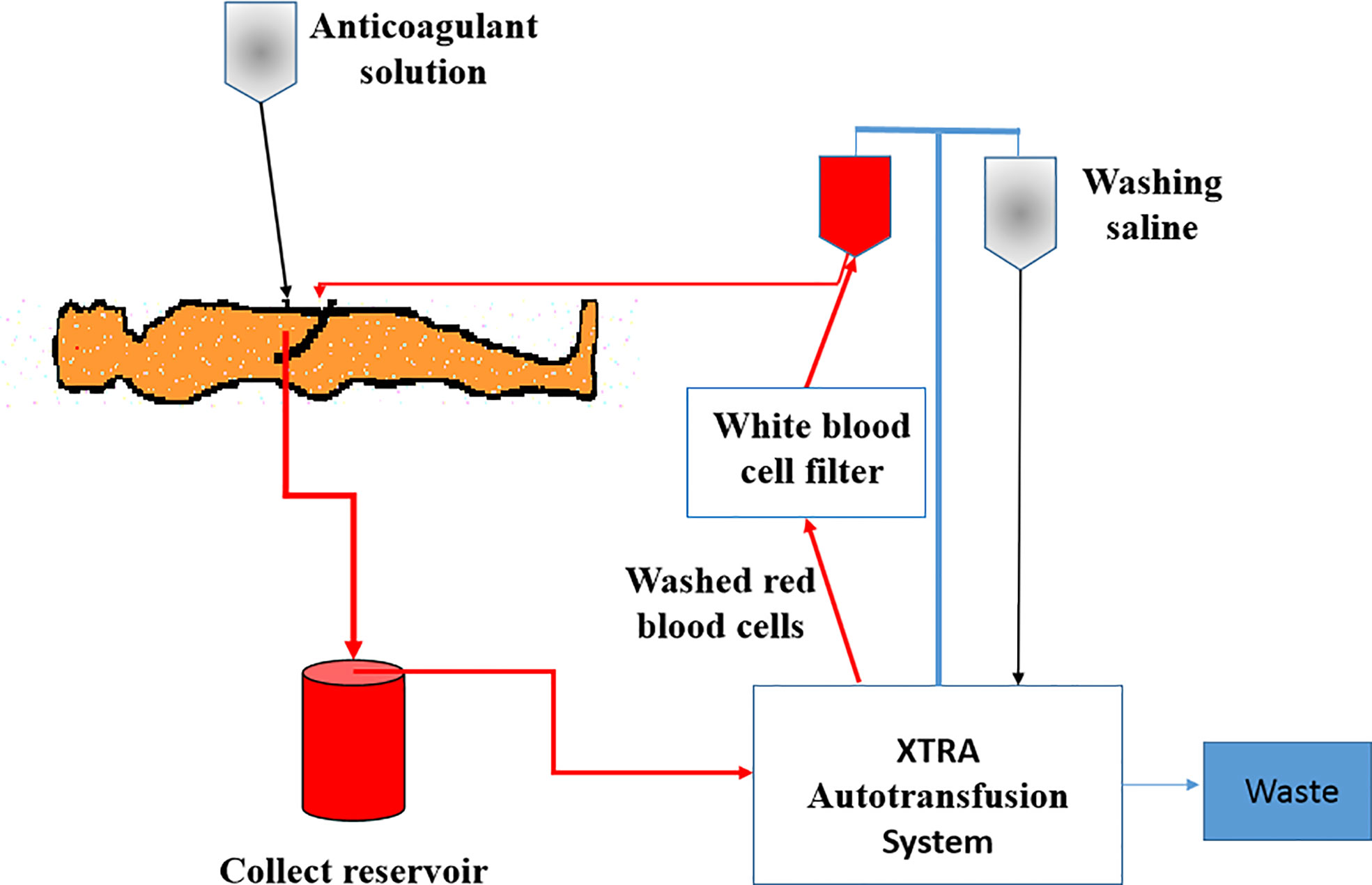 Frontiers Intraoperative cell salvage as an effective intervention