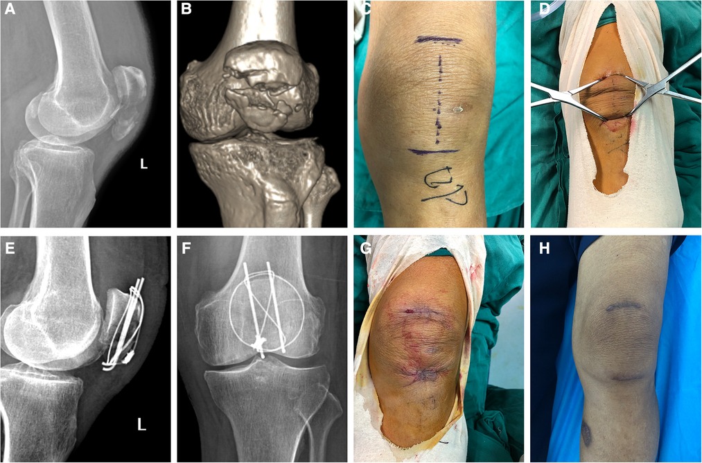 Neuromuscular Electrical Stimulation And Quadriceps Strength Following  Patellar Fracture And Open Reduction Internal Fixation Surgery: A Case  Report