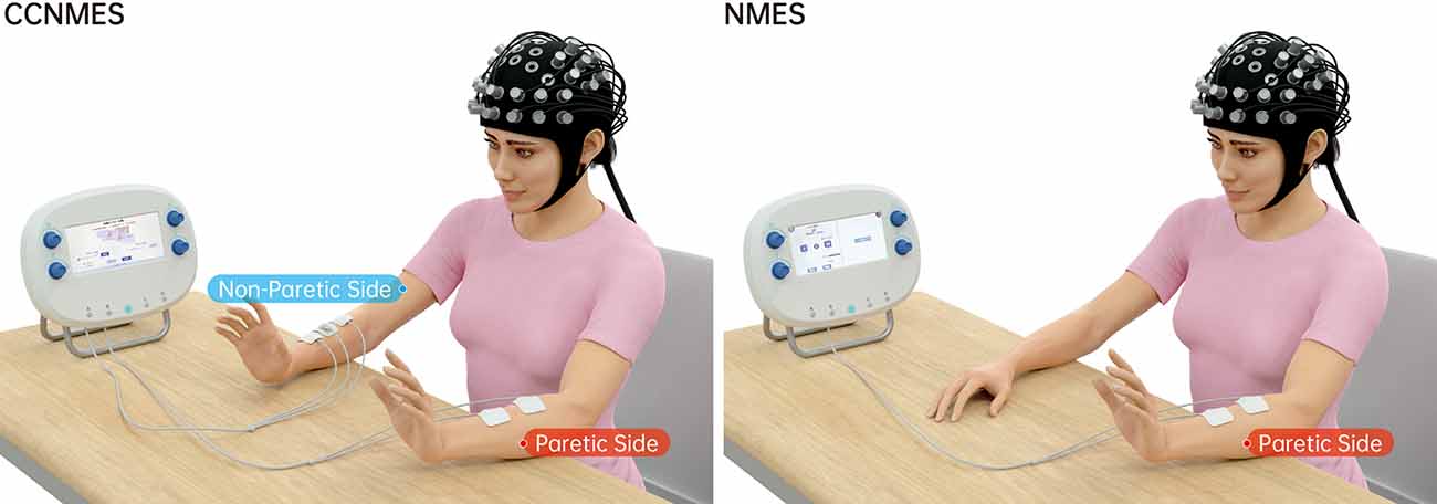 Modified neuromuscular electrical stimulation system can track the