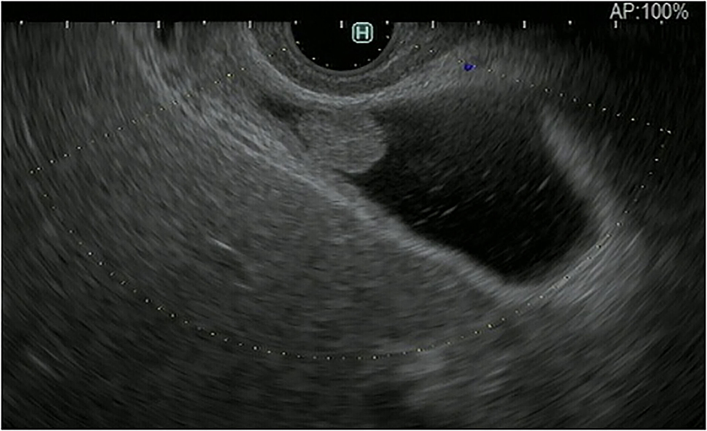 Gallbladder Carcinoma Ultrasound