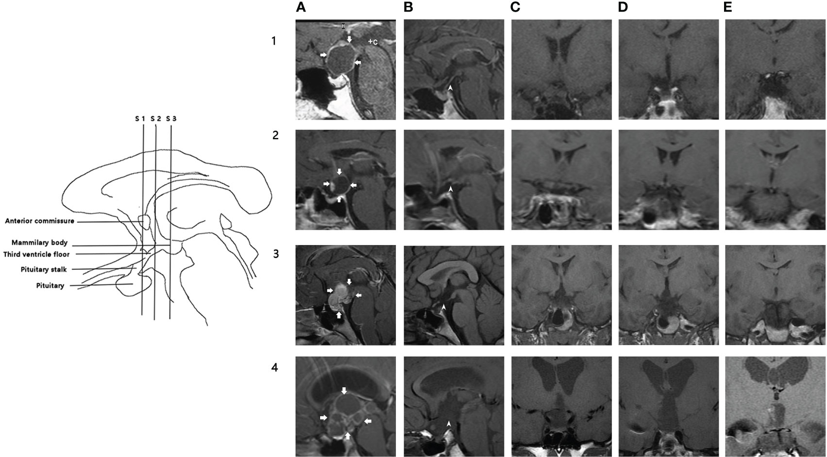 Frontiers | Relationship between postoperative hypothalamic injury