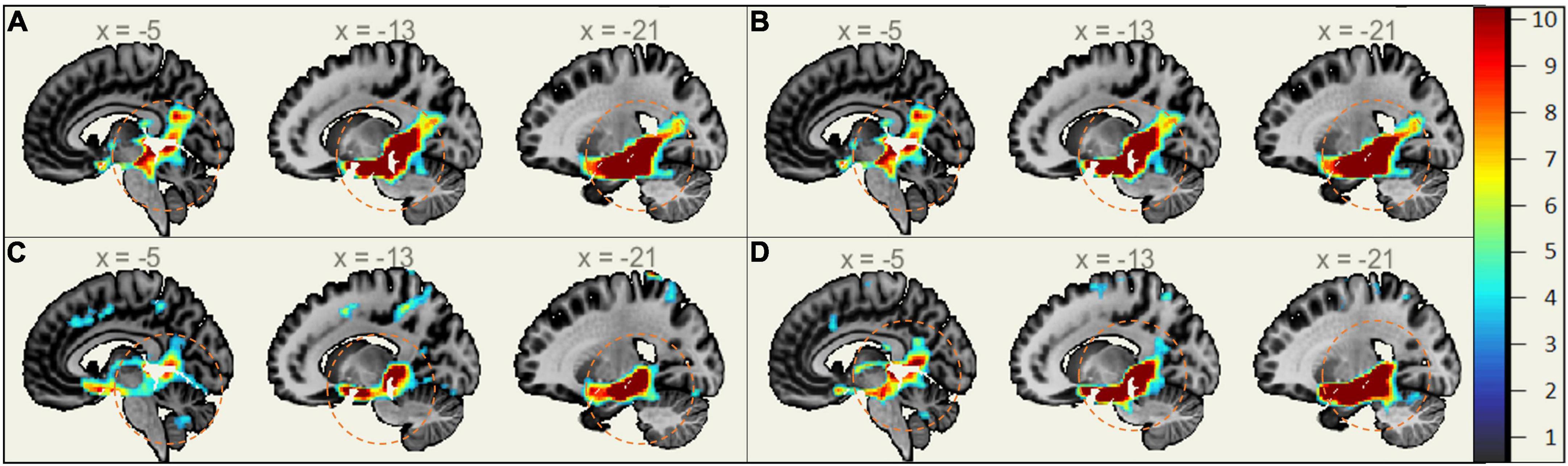 Frontiers Sex Differences In Brain Functional Connectivity Of Hippocampus In Mild Cognitive