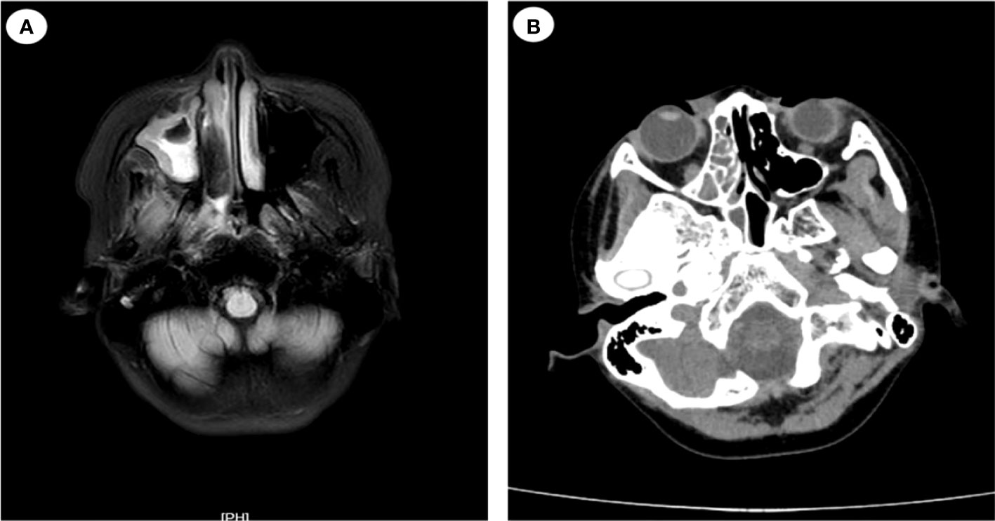 Frontiers | Nasal and cutaneous mucormycosis in two patients with ...