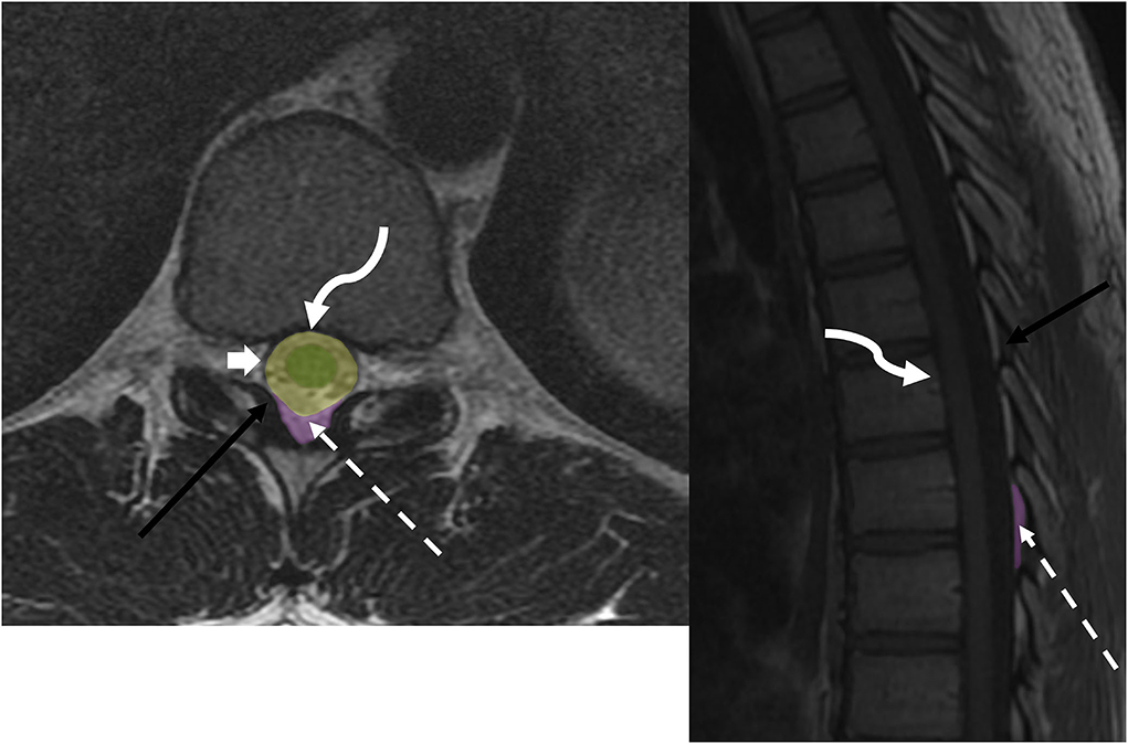Frontiers  Imaging of metastatic epidural spinal cord compression