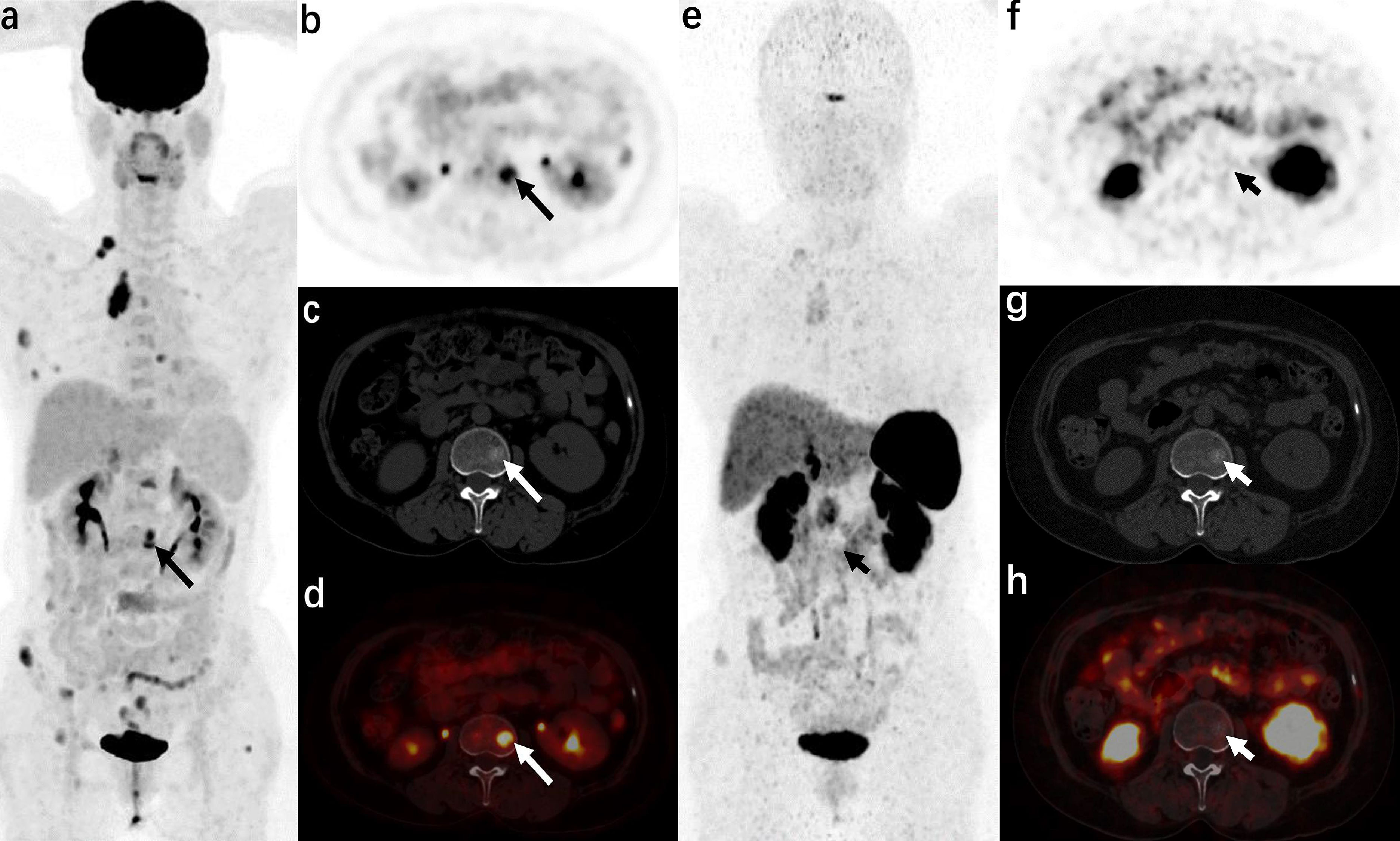 Frontiers | Comparison of diagnostic efficacy of 18F-FDG PET/CT and ...
