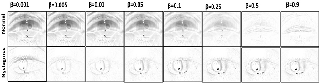 Frontiers  aEYE: A deep learning system for video nystagmus detection