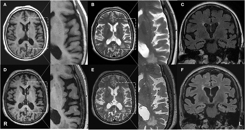 Frontiers | Case Report: A neurolinguistic and neuroimaging study 