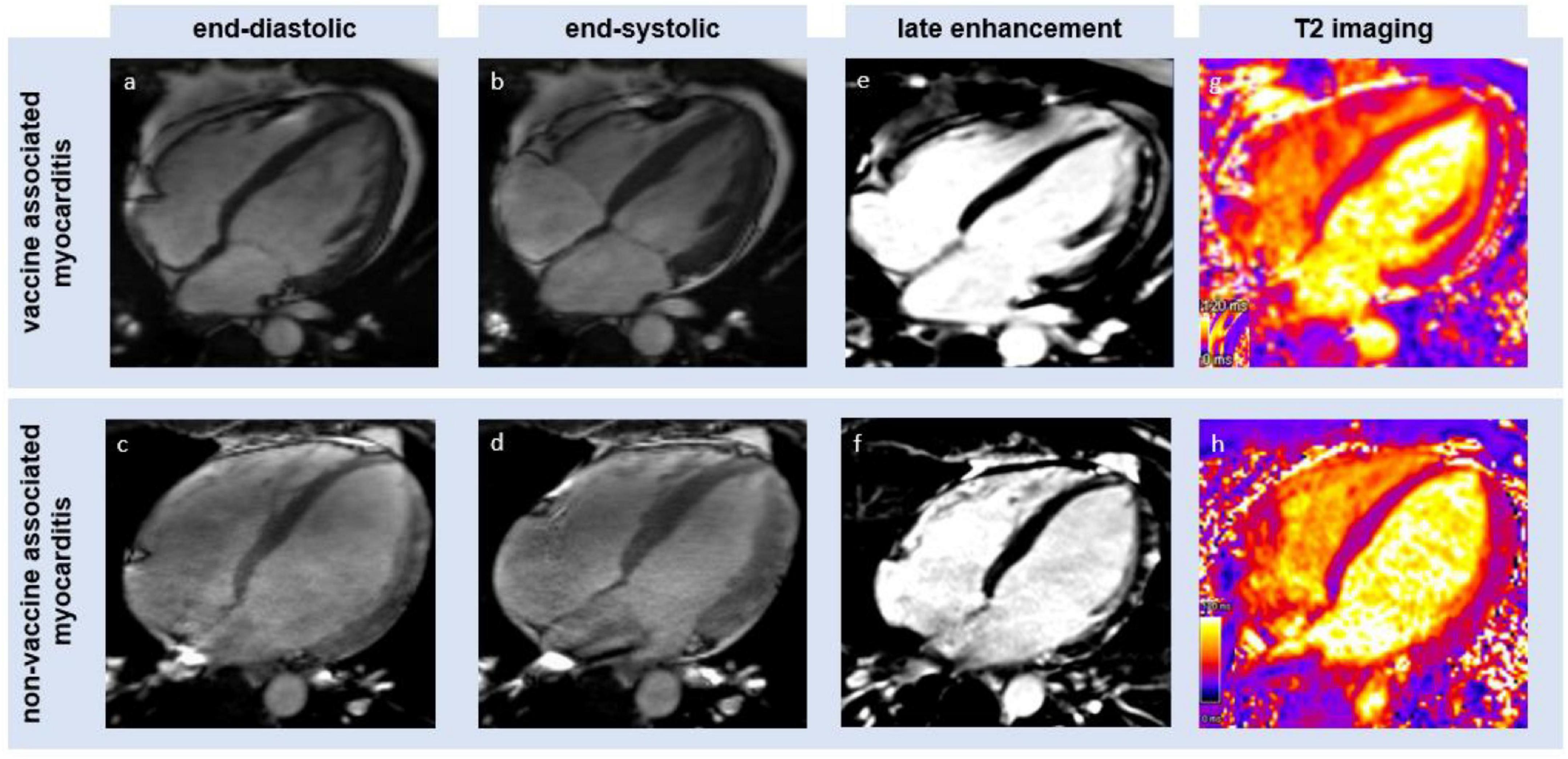Clinical applications of feature-tracking cardiac magnetic resonance imaging
