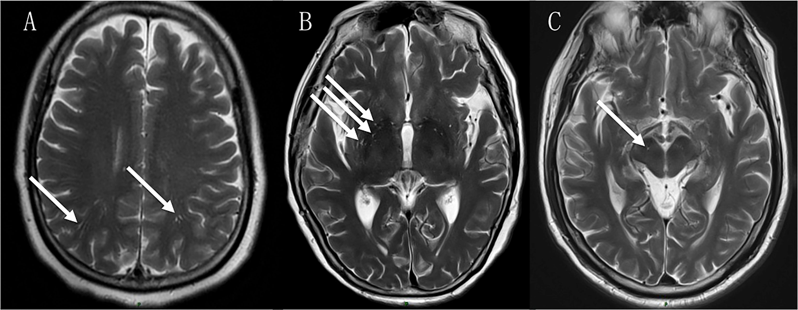 Frontiers Enlarged perivascular spaces, neuroinflammation and neurological dysfunction in NMOSD patients photo