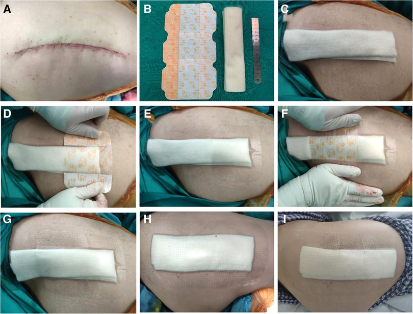 PDF] Efficacy of adhesive strips to reduce postoperative