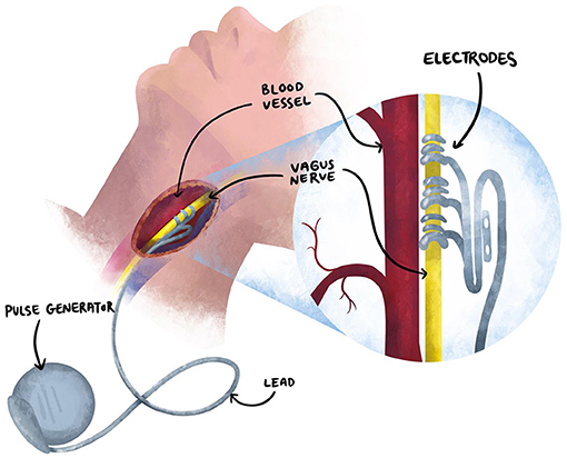 图3 -迷走神经刺激法的装置,脑外科医生使颈部的皮肤切口将电极周围的VNS迷走神经。