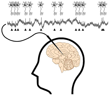 图1 -如果将电极(针状装置)植入大脑，我们可以测量电极旁边神经元的信号。