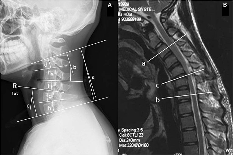 Frontiers  The radiological and electrophysiological characteristics of  Hirayama disease with proximal involvement: A retrospective study