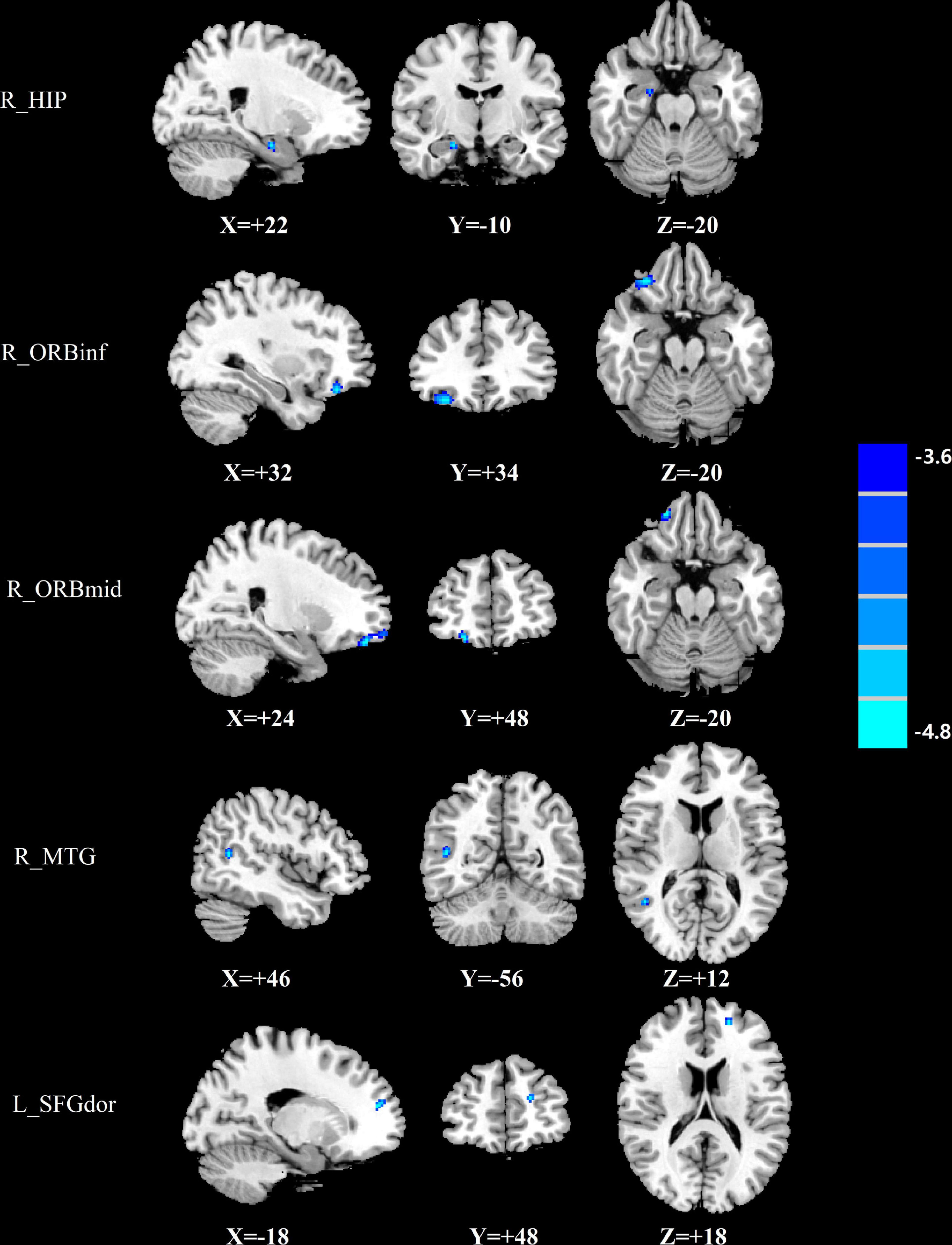 Frontiers | Cerebral blood flow network differences correlated 