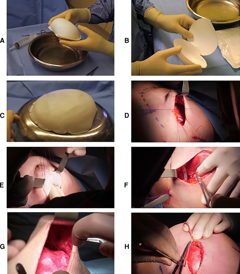 Implant-based breast reconstruction using a titanium-coated