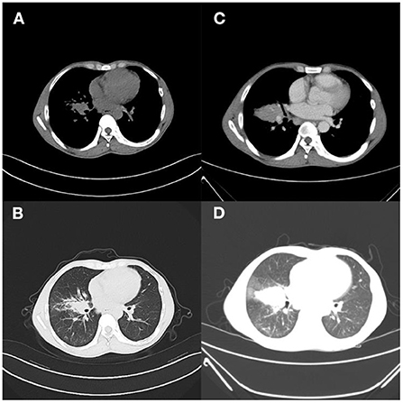 Frontiers  The Rise of Non-Tuberculosis Mycobacterial Lung Disease