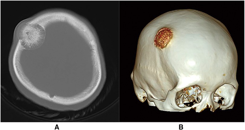 Preoperative frontal view that demonstrates a red, round bulge in the