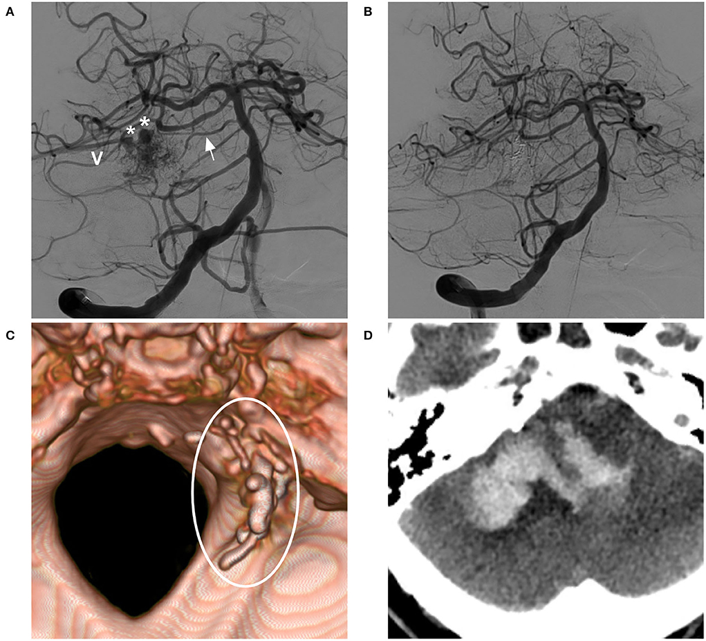 JCDR - Arteriovenous malformation, Onyx, Seizure