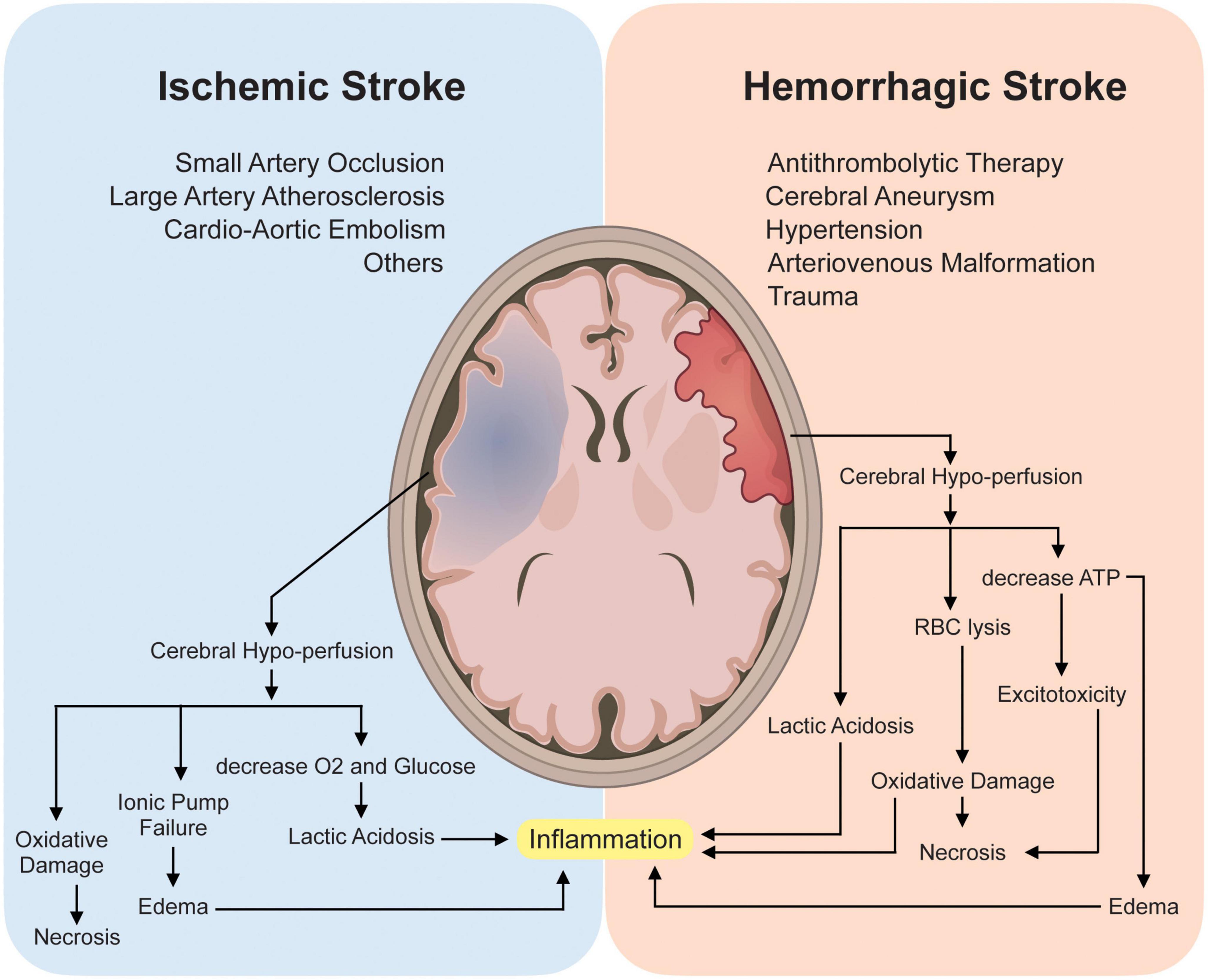 Hemorrhagic Stroke Pathophysiology