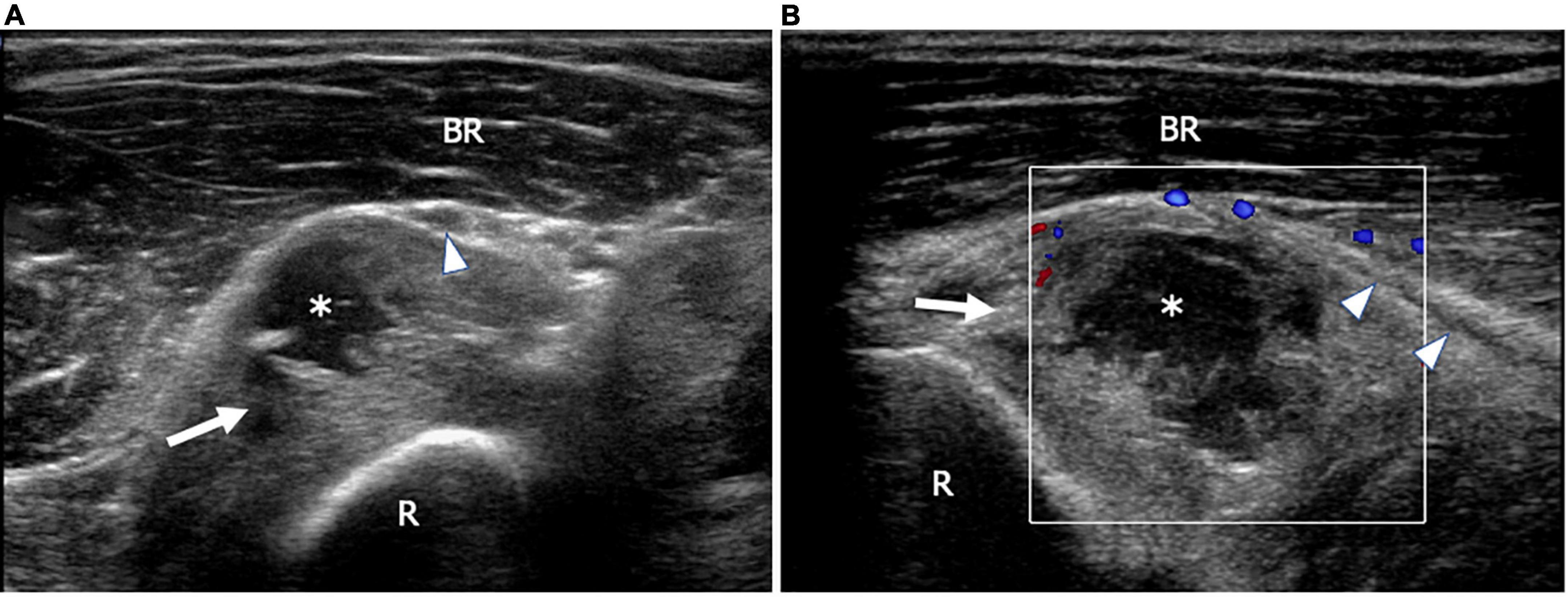 Frontiers  High-resolution ultrasound of peripheral neuropathies
