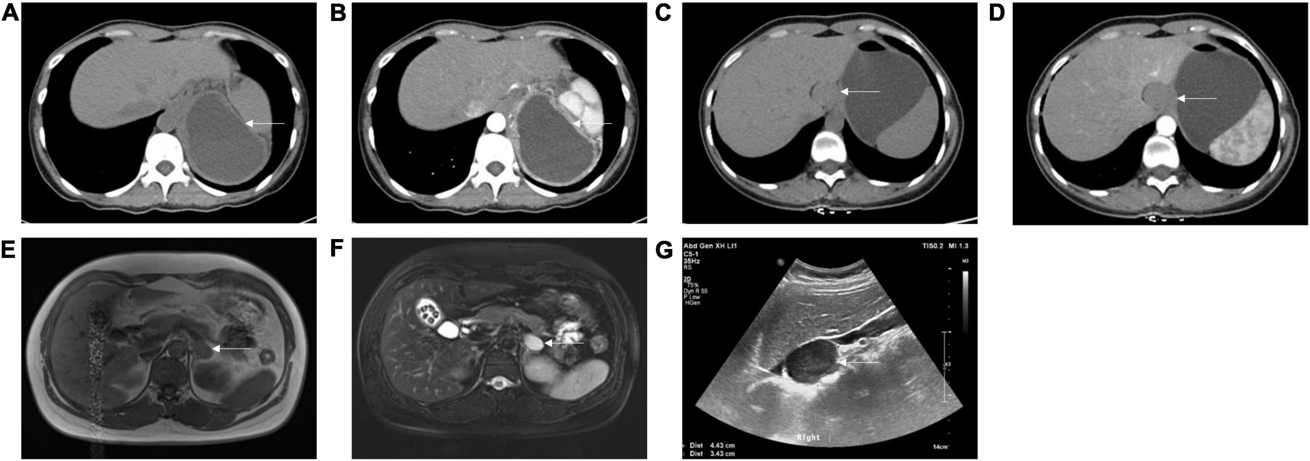 4288px x 1510px - Frontiers | Subdiaphragmatic bronchogenic cysts: Case series and literature  review
