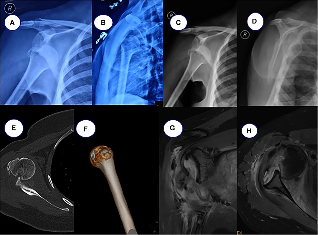 Frontiers  Case report of old anterior dislocation of the shoulder joint  and review of the literature