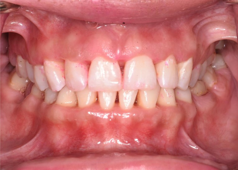 necrotizing ulcerative gingivitis vs necrotizing ulcerative periodontitis