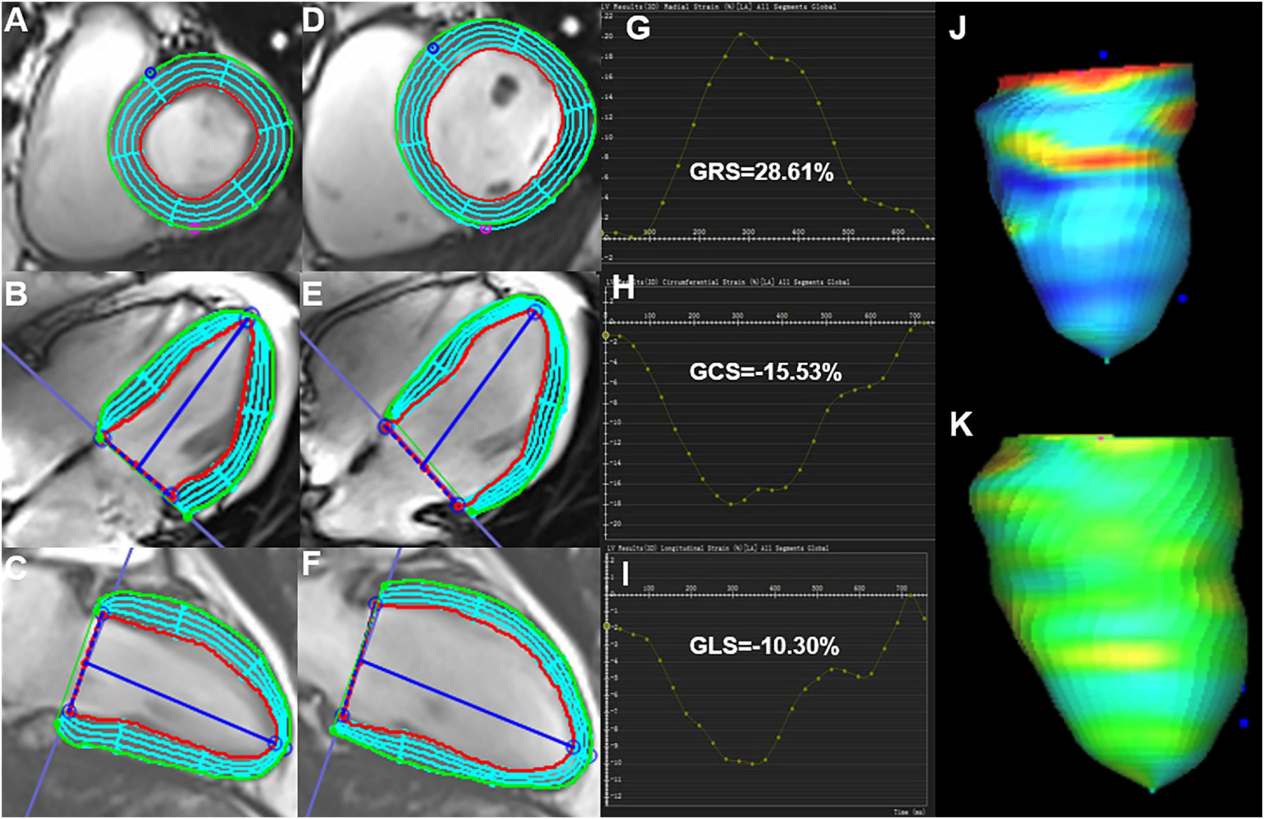 Global Longitudinal Strain Analysis Using Cardiac MRI in Aortic