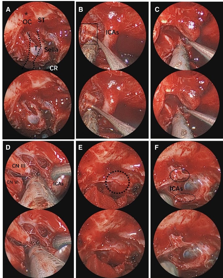 Frontiers | The use of three-dimensional endoscope in transnasal 