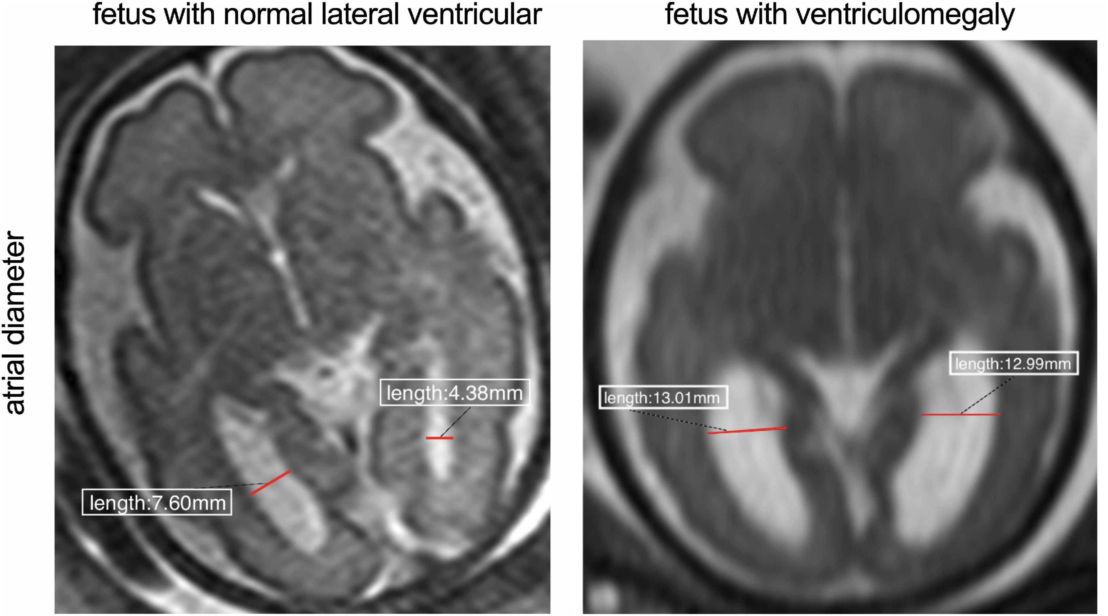 ventriculomegaly ultrasound
