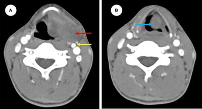 Frontiers | Laryngeal extra-skeletal Ewing sarcoma treated with DC-CTL ...