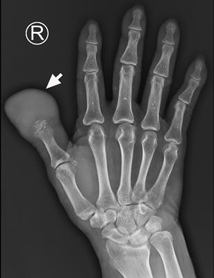 Frontiers | Case report: Malignant proliferating trichilemmal tumor of ...