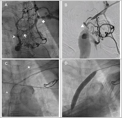 Frontiers | Proposed strategies to overcome venous occlusion in the ...