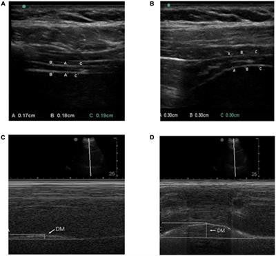 Frontiers | Repetitive transcranial magnetic stimulation combined with ...