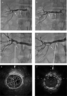 Frontiers | Case report: Recurrence of hypertension after renal artery  angioplasty due to the progression of focal renal fibromuscular dysplasia
