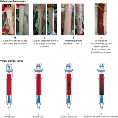 Frontiers | Risk for excessive anticoagulation during hemodialysis is ...