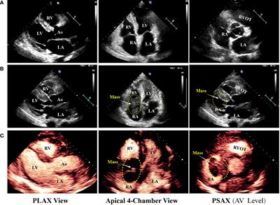 Frontiers | Diagnosis of rapidly progressed primary cardiac lymphoma in ...