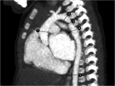 Frontiers | Computed tomography angiography assessment of the degree of ...