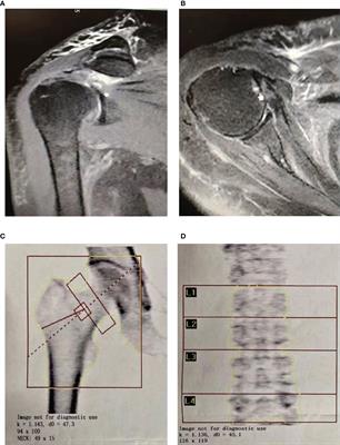 Frontiers | The role of vitamin D on rotator cuff tear with osteoporosis