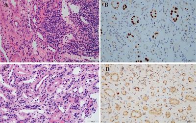 Frontiers | Basiliximab for the therapy of acute T cell–mediated ...