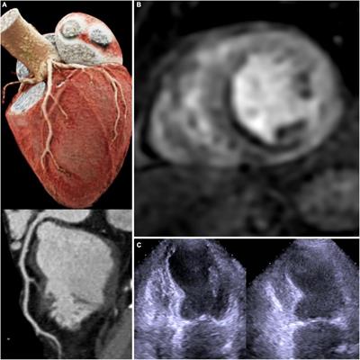 Frontiers | The chronic coronary syndrome—Heart failure roundabout: A ...