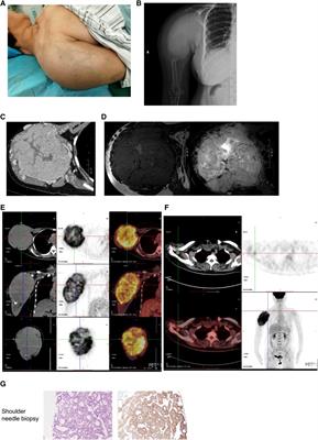 Extensive lymphatic spread of papillary thyroid microcarcinoma is  associated with an increase in expression of genes involved in  epithelial‐mesenchymal transition and cancer stem cell‐like properties -  Lee - 2019 - Cancer Medicine 