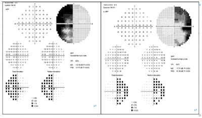 Frontiers | Spindle cell oncocytoma of the pituitary tumor: A rare case ...