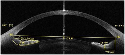 Frontiers | Prediction of excessively low vault after implantable ...