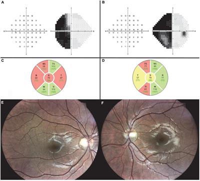 The grading system of optic disc images. (b) Outcomes of initial