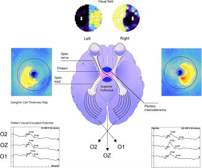 Frontiers | Bi-nasal sectors of ganglion cells complex and visual ...