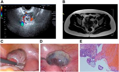 Frontiers  Unruptured ovarian ectopic pregnancy: Two case reports